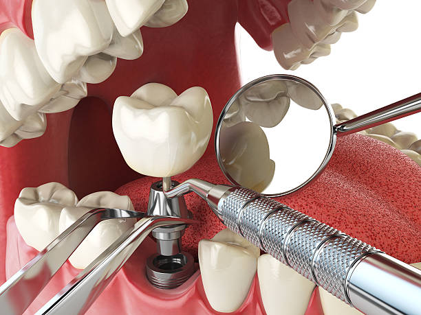 Best Emergency Treatment for Dental Infections or Abscesses in Central, SC